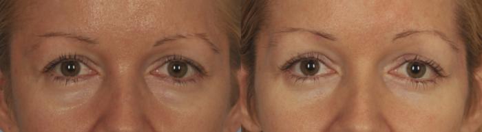 Before & After Blepharoplasty Case 44 View #1 View in Toronto, ON