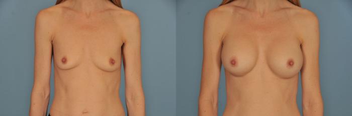 Before & After Breast Augmentation Case 15 View #1 View in Toronto, ON