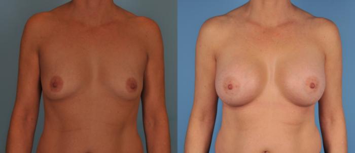 Before & After Breast Augmentation Case 20 View #1 View in Toronto, ON