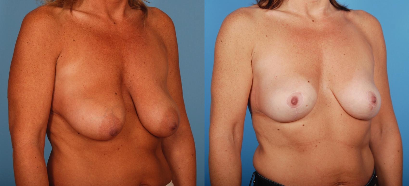 Before & After Breast Lift Case 35 View #1 View in Toronto, ON