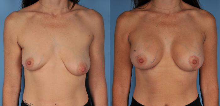 Before & After Breast Lift Case 81 View #1 View in Toronto, ON