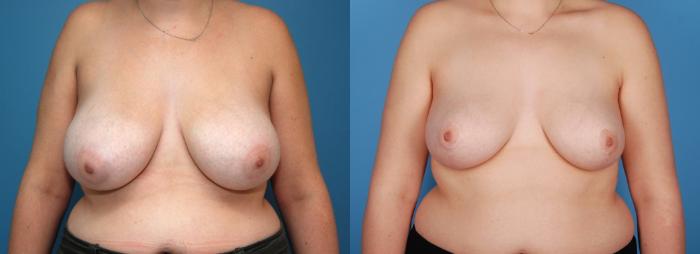 Before & After Breast Reduction Case 22 View #1 View in Toronto, ON