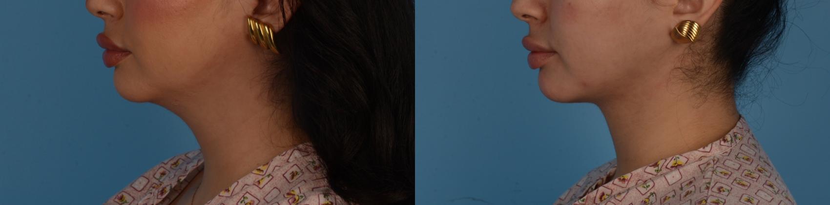 Before & After Facelift/Neck Lift Case 329 Left Side View in Toronto, ON