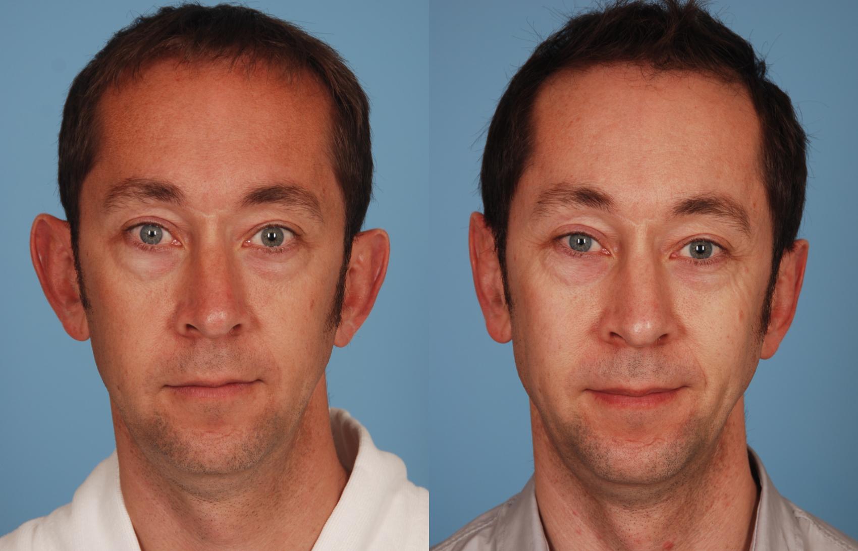 Before & After Otoplasty Case 129 View #1 View in Toronto, ON