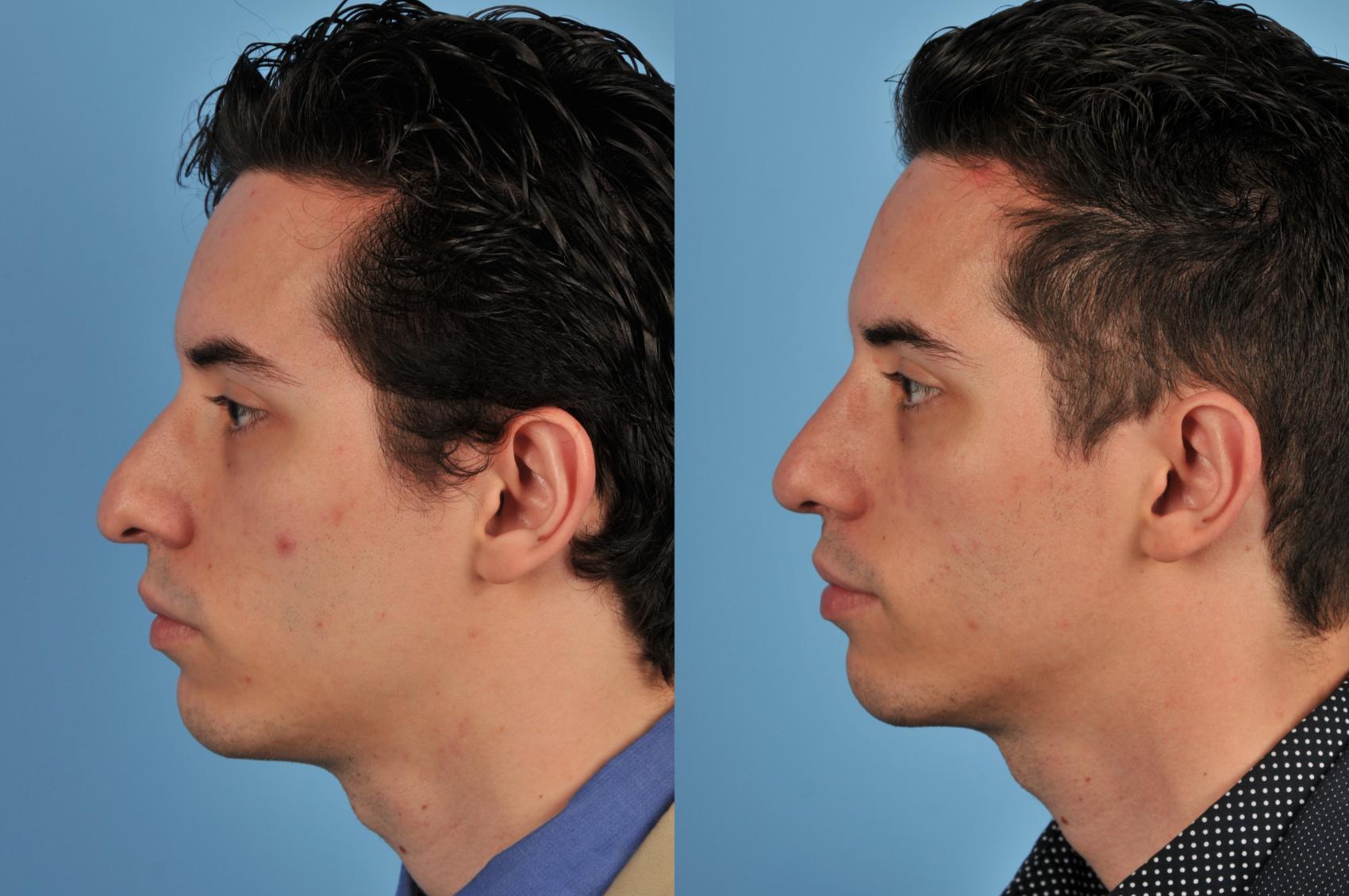 Before & After Rhinoplasty Case 73 View #1 View in Toronto, ON