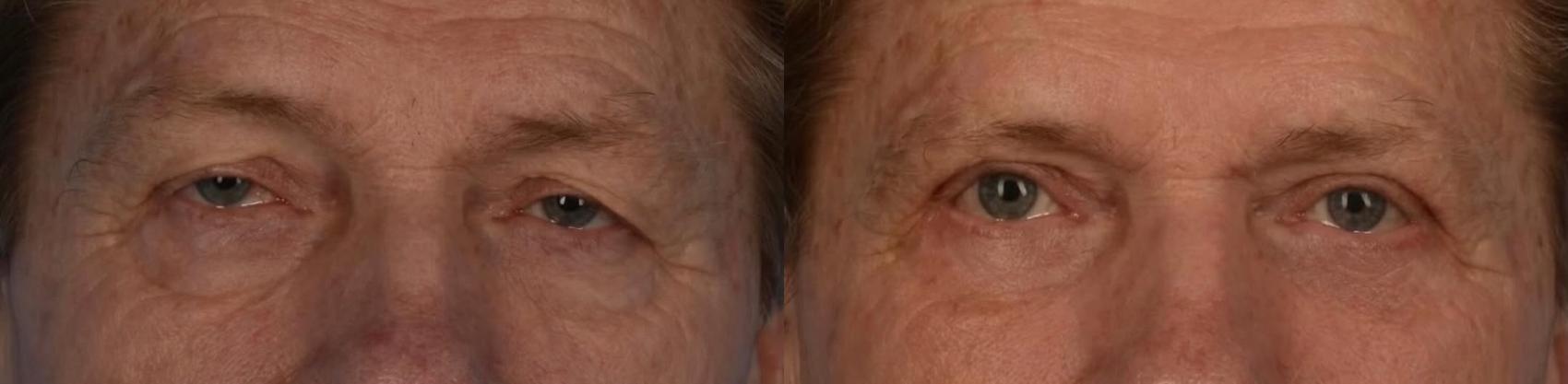 Before & After Upper Blepharoplasty with Ptosis Correction Case 323 Front View in Toronto, ON