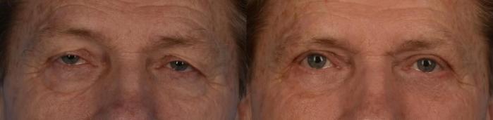 Before & After Upper Blepharoplasty with Ptosis Correction Case 323 Front View in Toronto, ON