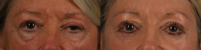 Before & After Upper Blepharoplasty with Ptosis Correction Case 330 Front View in Toronto, ON