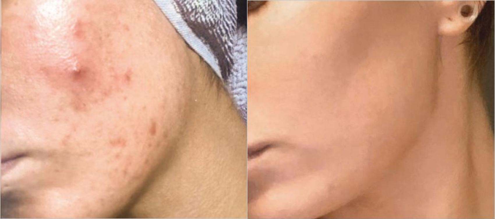 Before & After BBL® Laser Skin Rejuvenation Case 245 Right Oblique View in Toronto, ON