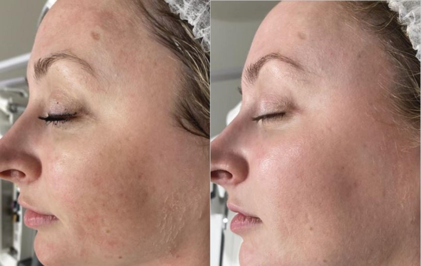 Before & After BBL® Laser Skin Rejuvenation Case 247 Left Side View in Toronto, ON