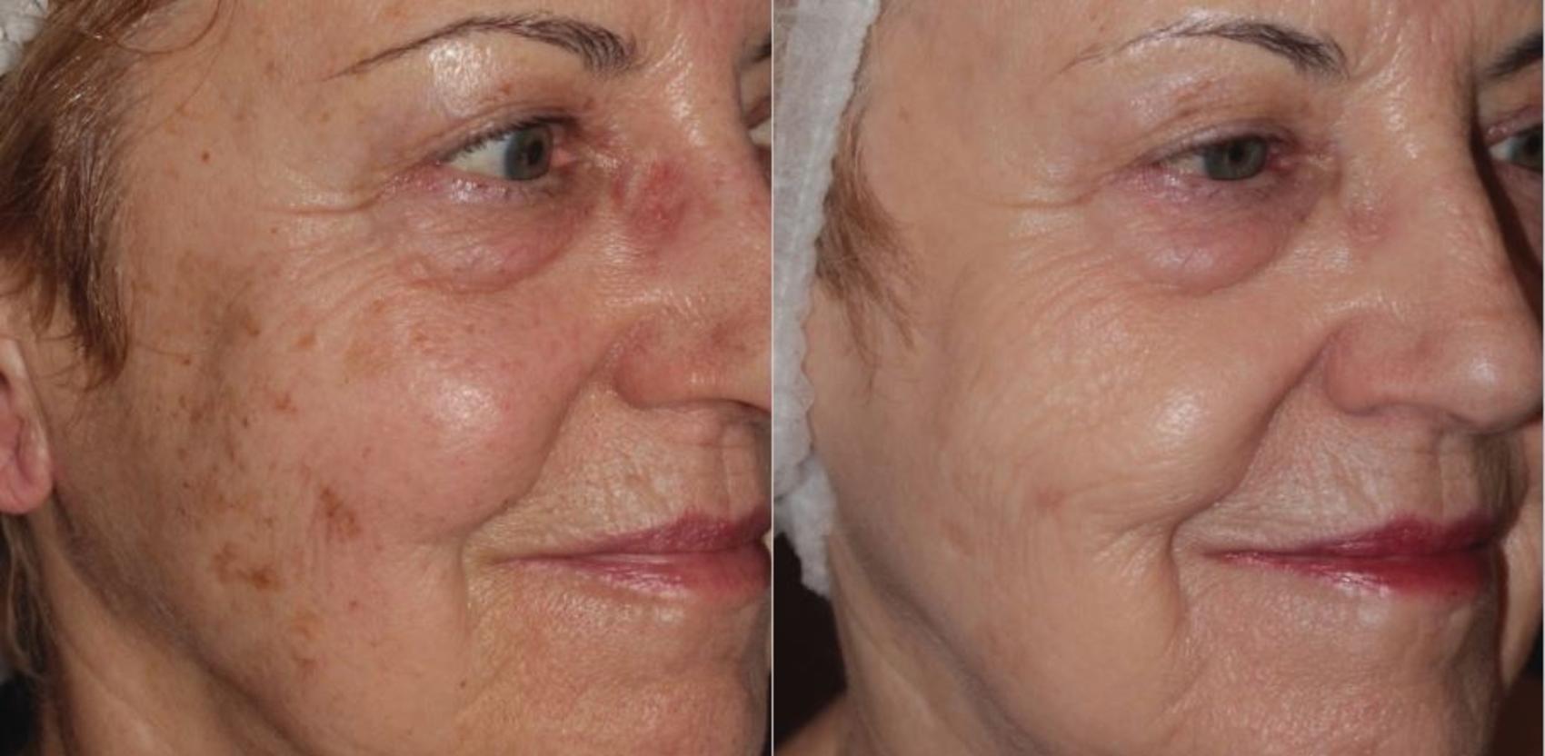 Before & After BBL® Laser Skin Rejuvenation Case 250 Right Oblique View in Toronto, ON