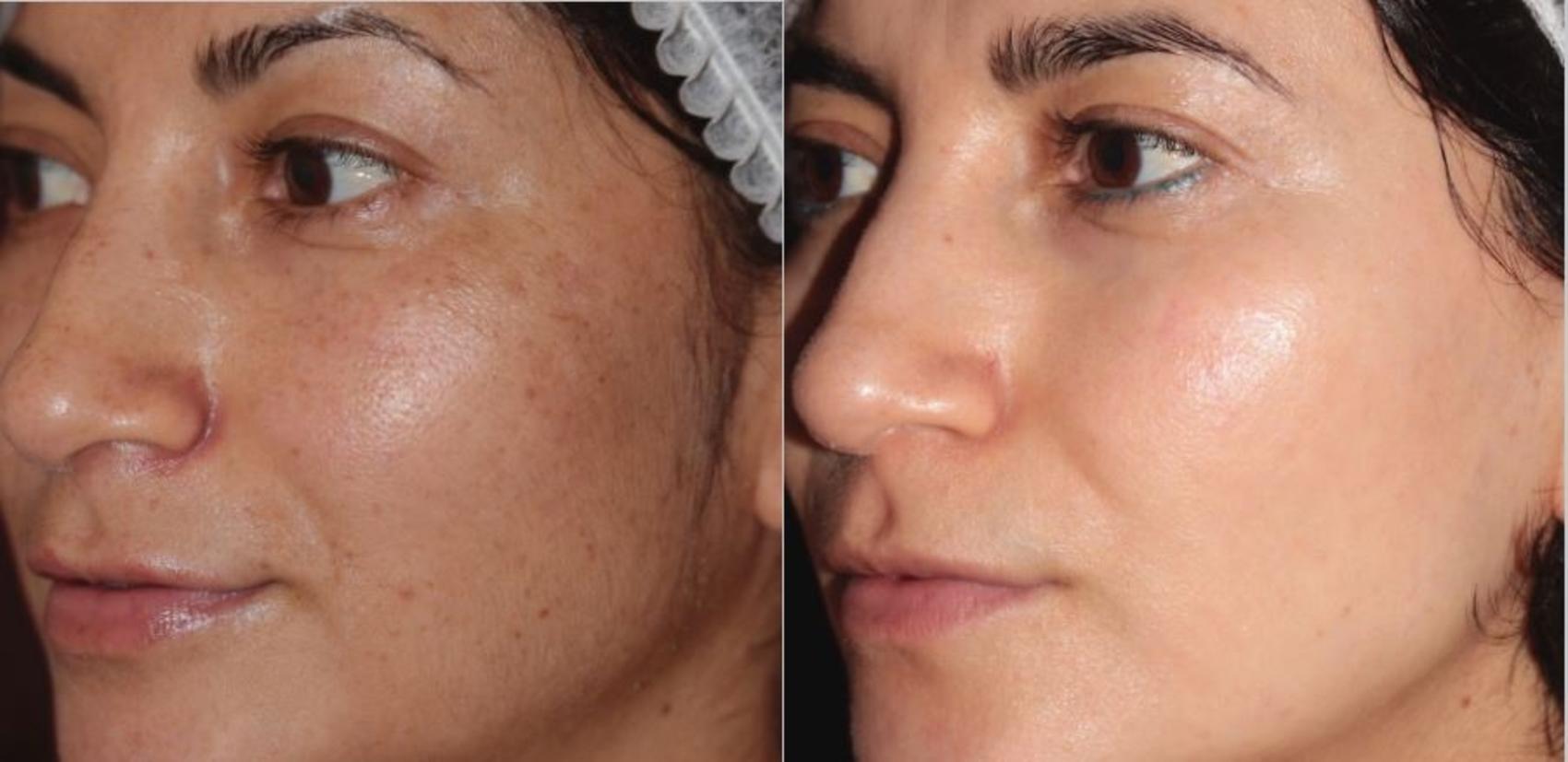 Before & After BBL® Laser Skin Rejuvenation Case 251 Left Oblique View in Toronto, ON