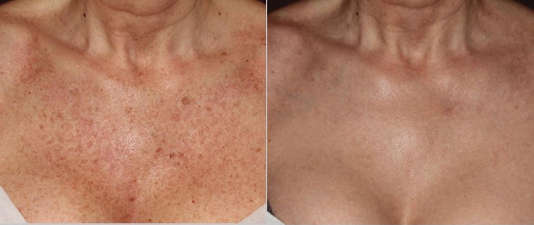Before & After BBL® Laser Skin Rejuvenation Case 252 Front View in Toronto, ON