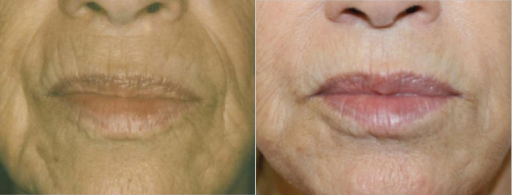 Before & After BBL® Laser Skin Rejuvenation Case 254 Front View in Toronto, ON