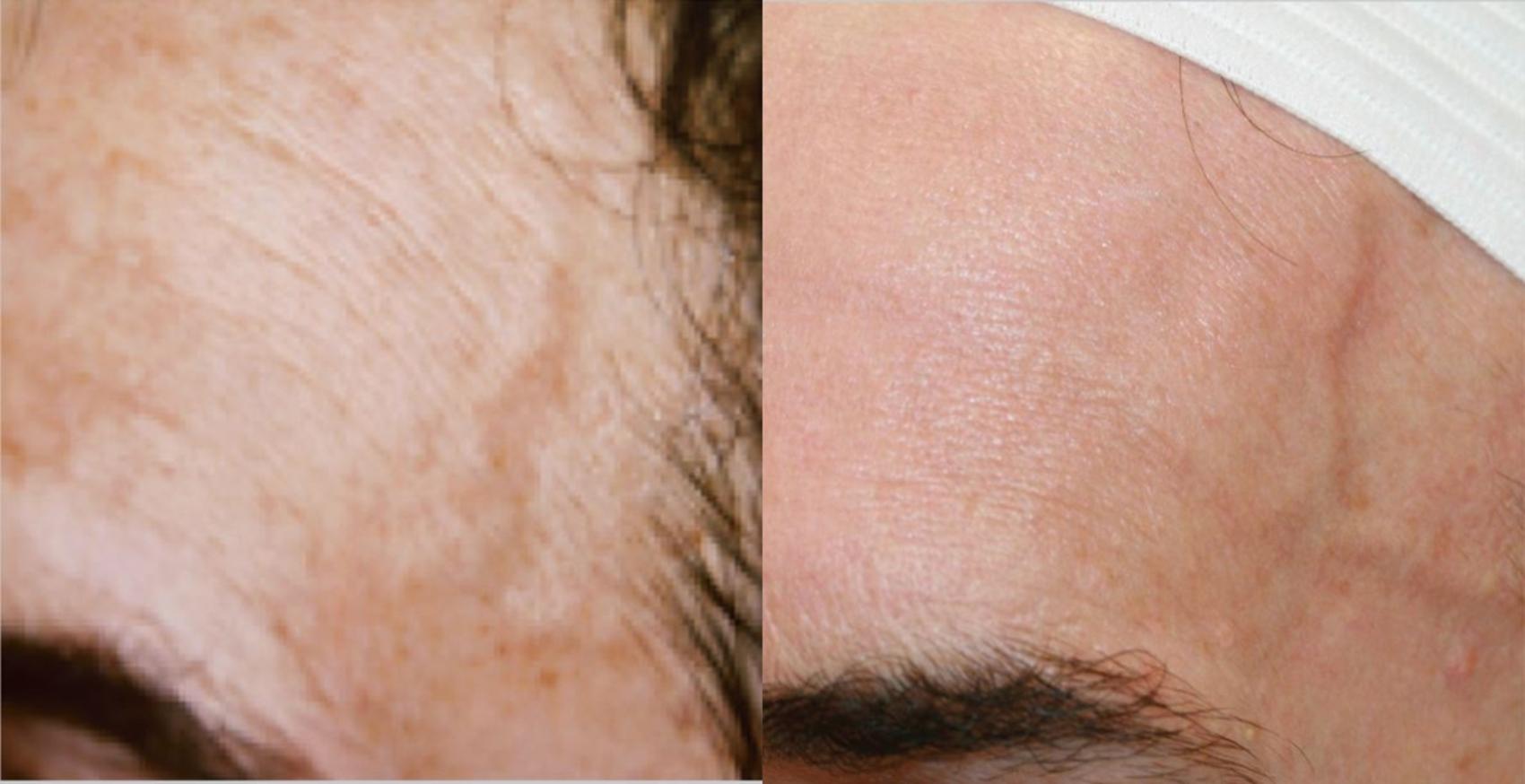 Before & After BBL® Laser Skin Rejuvenation Case 255 Left Oblique View in Toronto, ON