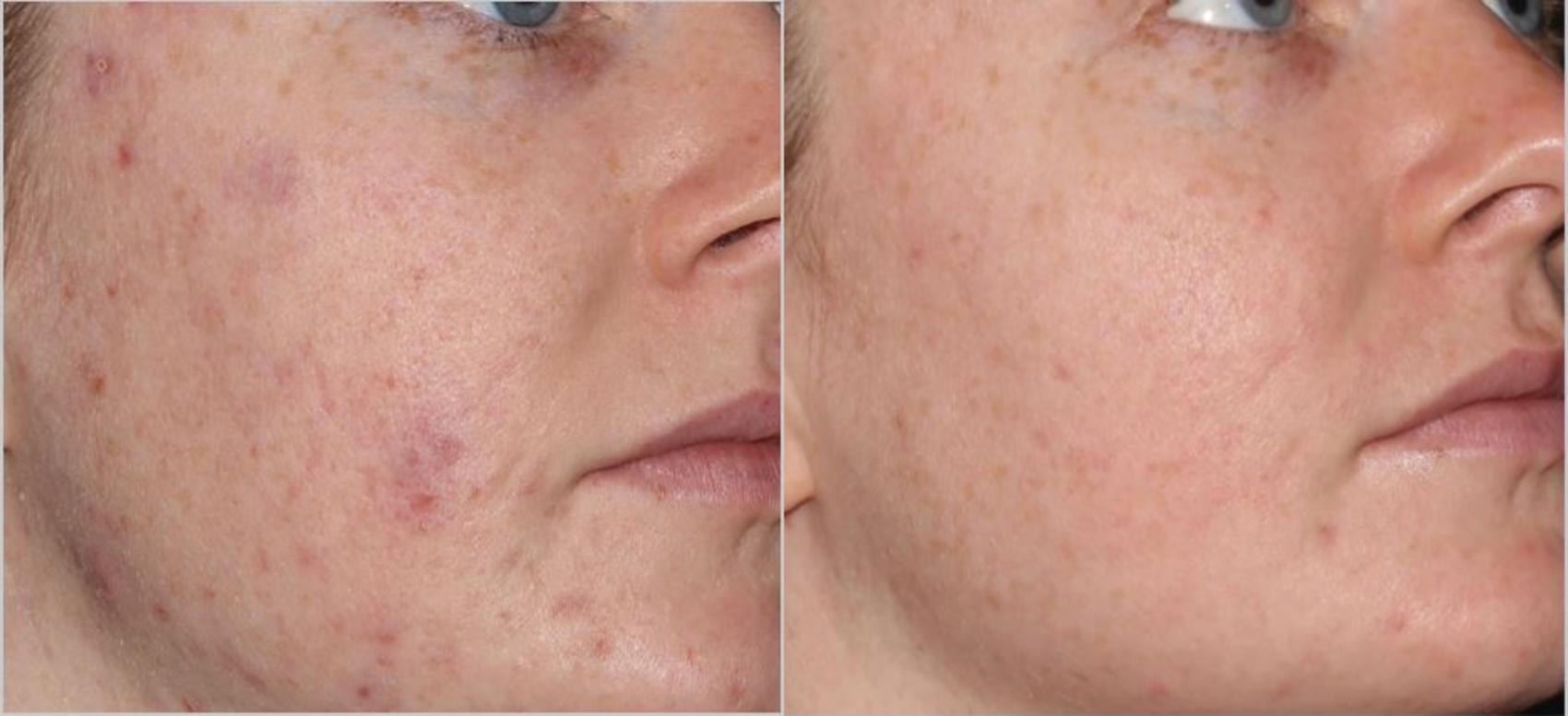 Before & After BBL® Laser Skin Rejuvenation Case 256 Right Oblique View in Toronto, ON