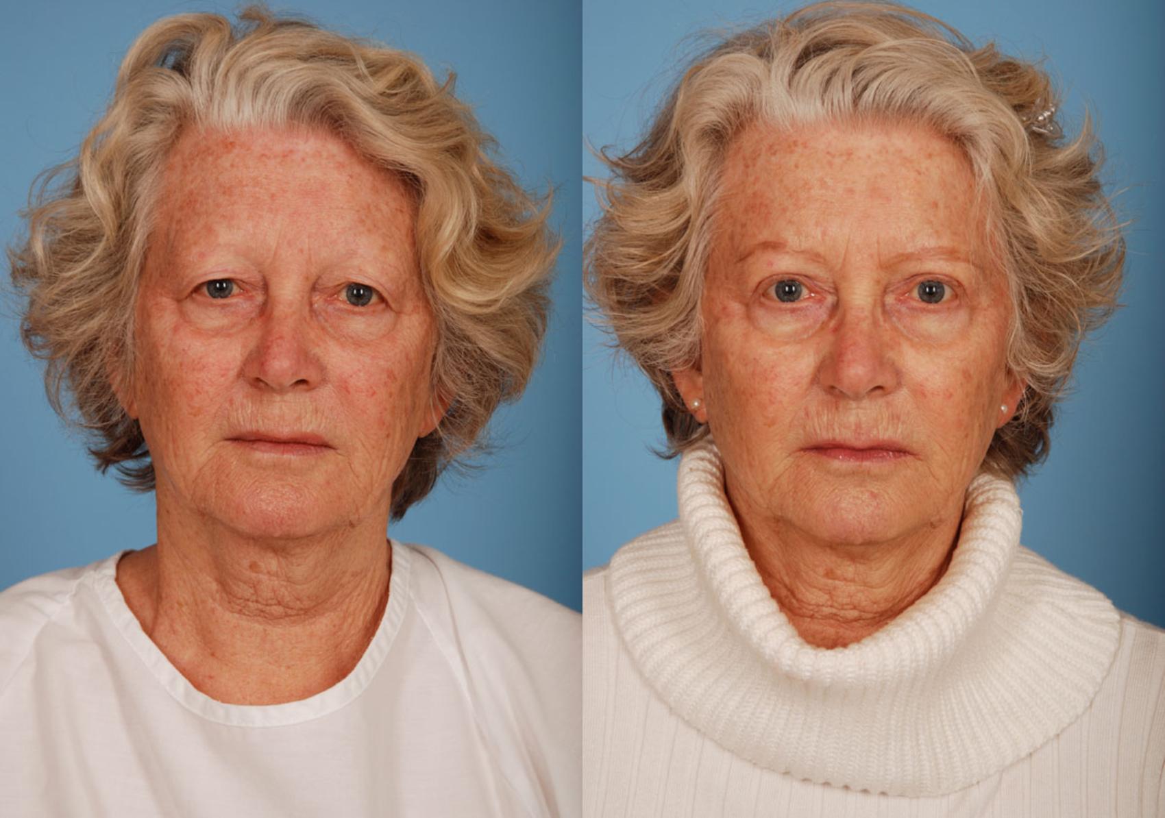Before & After Blepharoplasty Case 10 View #1 View in Toronto, ON