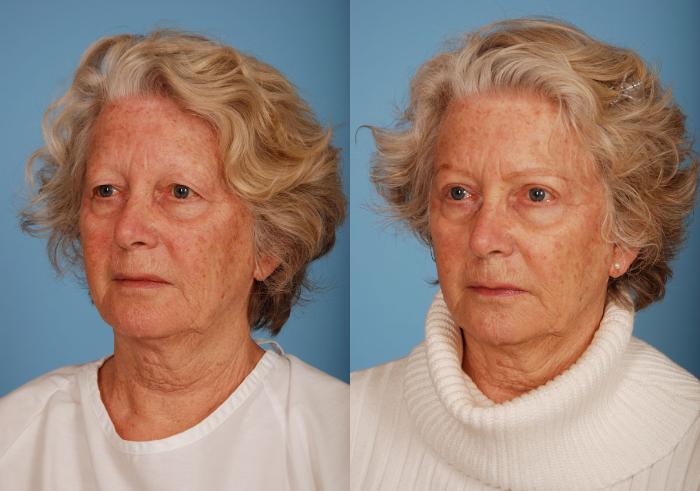 Before & After Blepharoplasty Case 10 View #2 View in Toronto, ON