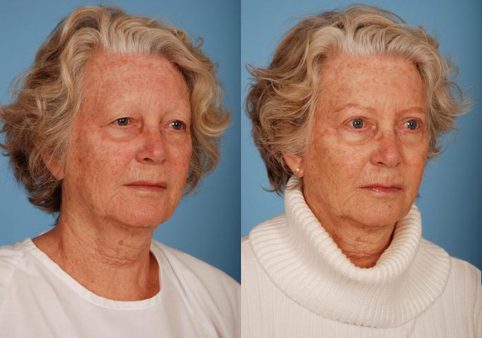 Before & After Blepharoplasty Case 10 View #3 View in Toronto, ON