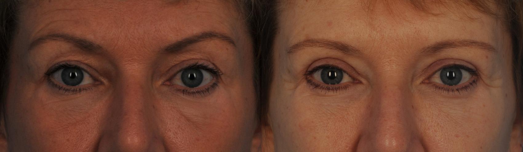 Before & After Blepharoplasty Case 100 View #1 View in Toronto, ON