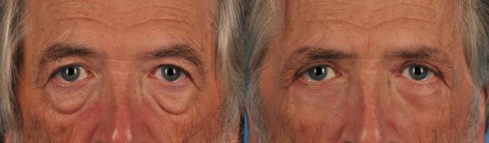 Before & After Blepharoplasty Case 105 View #1 View in Toronto, ON