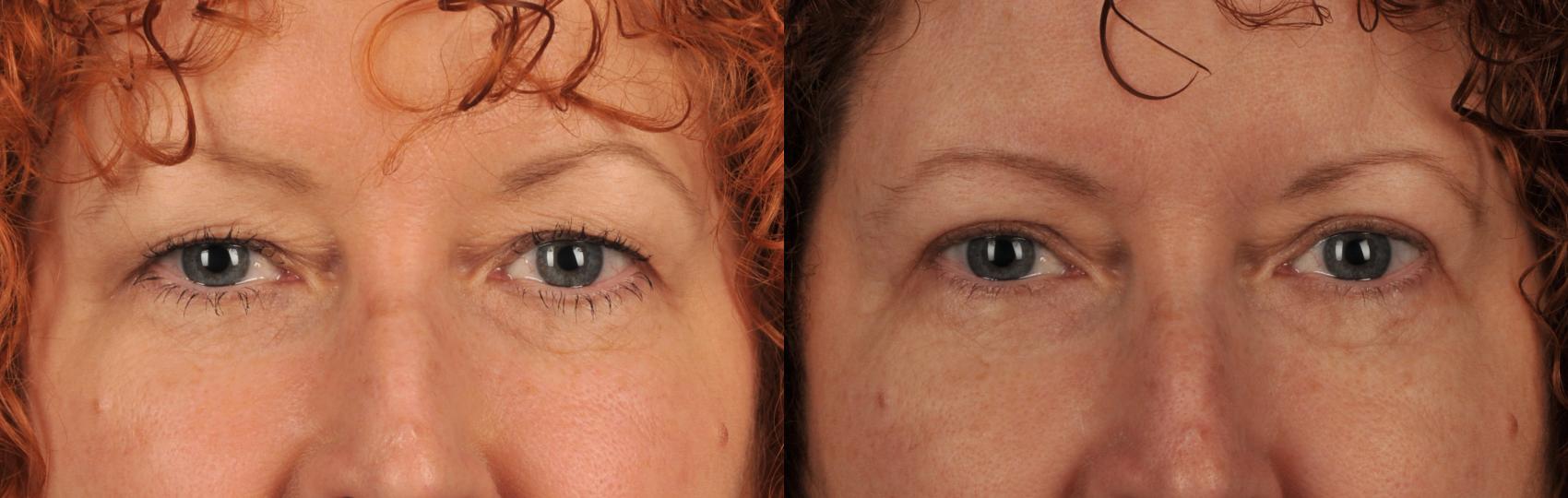 Before & After Blepharoplasty Case 106 View #1 View in Toronto, ON