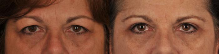 Before & After Blepharoplasty Case 107 View #1 View in Toronto, ON