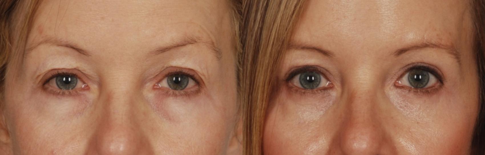 Before & After Blepharoplasty Case 110 View #1 View in Toronto, ON