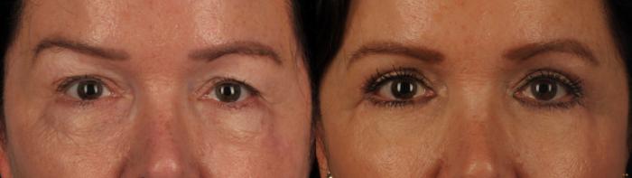 Before & After Blepharoplasty Case 114 View #1 View in Toronto, ON