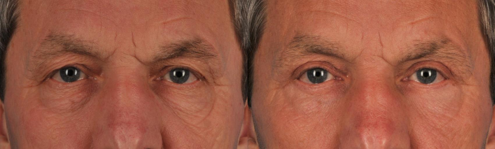 Before & After Blepharoplasty Case 115 View #1 View in Toronto, ON