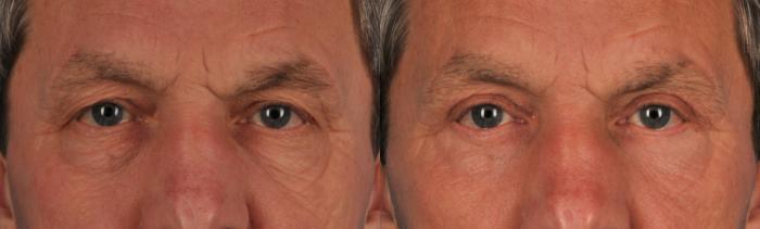 Before & After Blepharoplasty Case 115 View #1 View in Toronto, ON