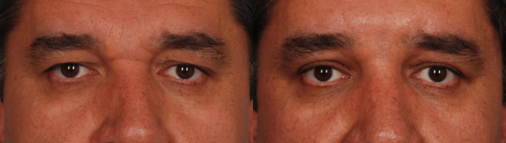 Before & After Blepharoplasty Case 117 View #1 View in Toronto, ON