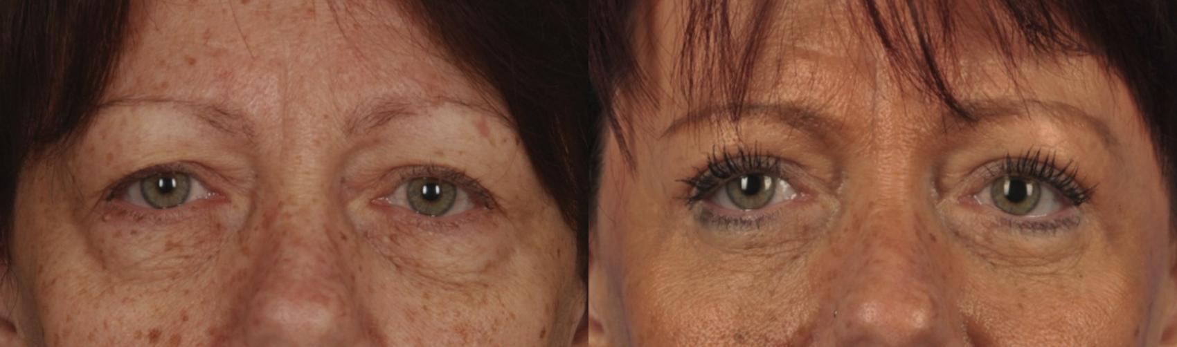 Before & After Blepharoplasty Case 118 View #1 View in Toronto, ON