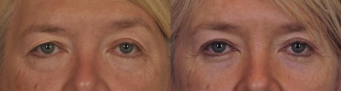 Before & After Blepharoplasty Case 119 View #1 View in Toronto, ON