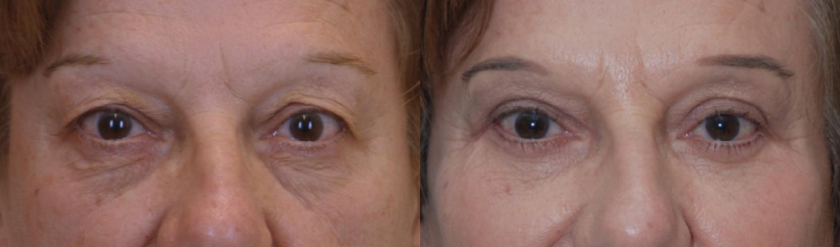 Before & After Blepharoplasty Case 121 View #1 View in Toronto, ON