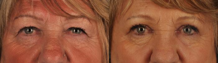 Before & After Blepharoplasty Case 124 View #1 View in Toronto, ON