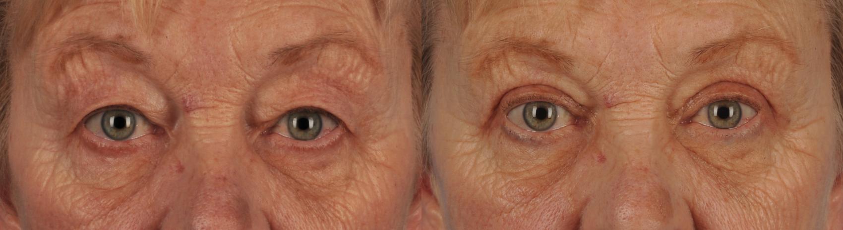 Before & After Blepharoplasty Case 125 View #1 View in Toronto, ON