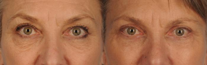 Before & After Blepharoplasty Case 127 View #1 View in Toronto, ON