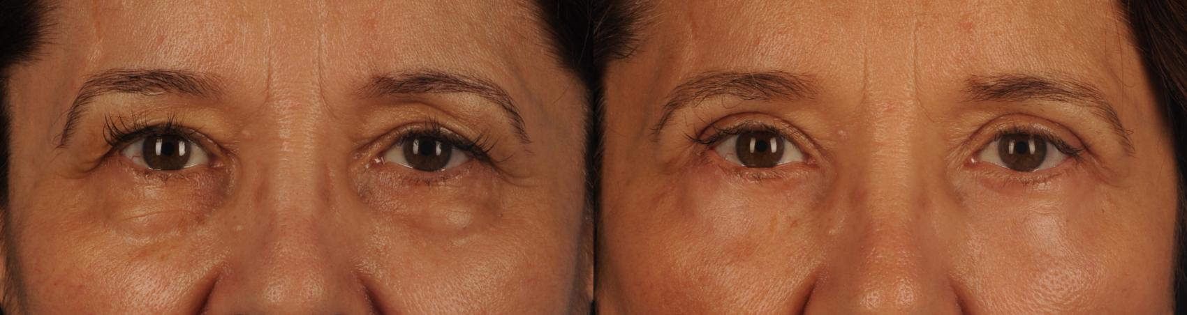 Before & After Blepharoplasty Case 128 View #1 View in Toronto, ON
