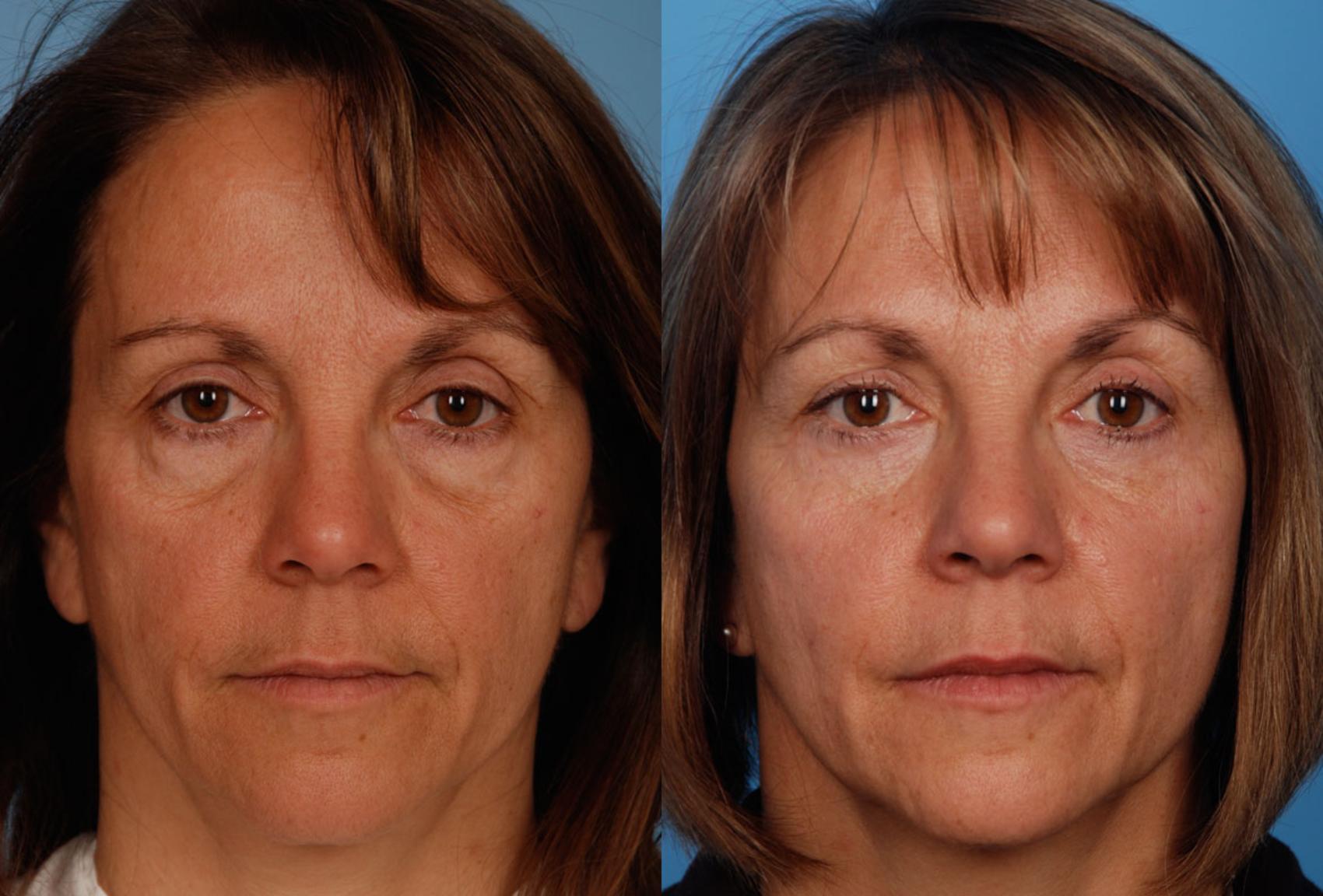 Before & After Blepharoplasty Case 13 View #1 View in Toronto, ON