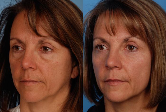Before & After Blepharoplasty Case 13 View #2 View in Toronto, ON