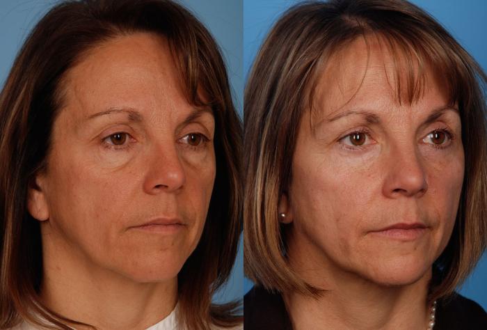 Before & After Blepharoplasty Case 13 View #3 View in Toronto, ON