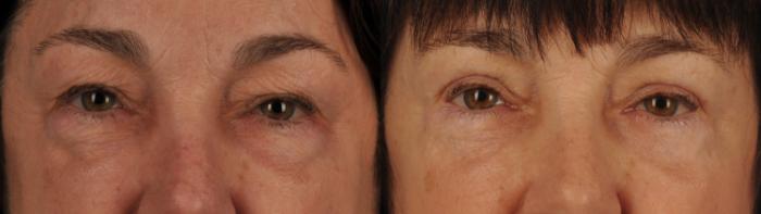 Before & After Blepharoplasty Case 131 View #1 View in Toronto, ON