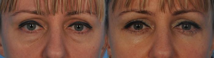 Before & After Blepharoplasty Case 132 View #1 View in Toronto, ON
