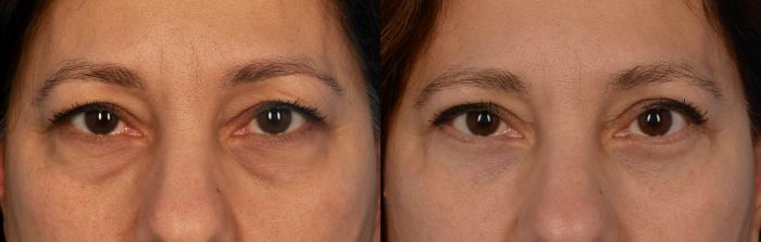 Before & After Blepharoplasty Case 138 View #1 View in Toronto, ON