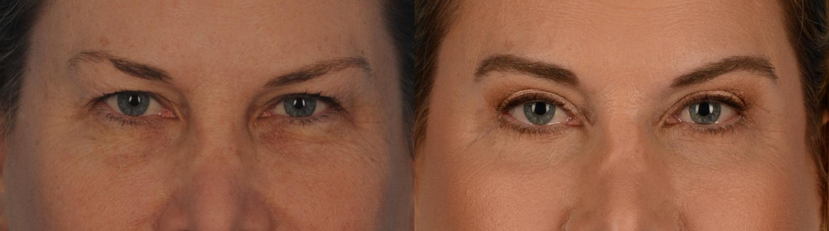 Before & After Blepharoplasty Case 143 View #1 View in Toronto, ON