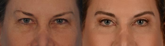Before & After Blepharoplasty Case 143 View #1 View in Toronto, ON