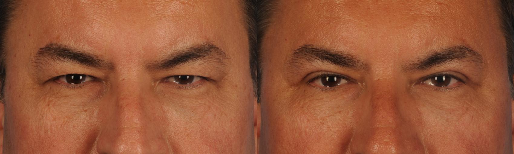 Before & After Blepharoplasty Case 144 View #1 View in Toronto, ON