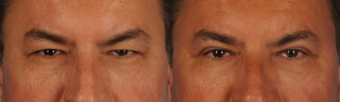 Before & After Blepharoplasty Case 144 View #1 View in Toronto, ON