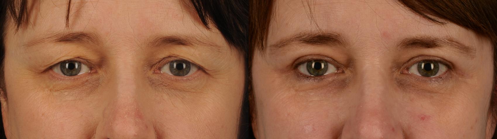 Before & After Blepharoplasty Case 146 View #1 View in Toronto, ON